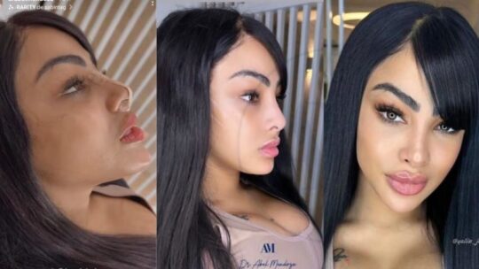 Cirujano de Yailín La Más Viral revela detalles de sus recientes procedimientos estéticos